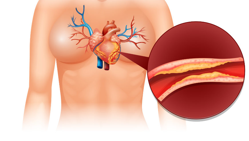 CT Coronary Angiography Price – Cost, Procedure & Benefits Explained