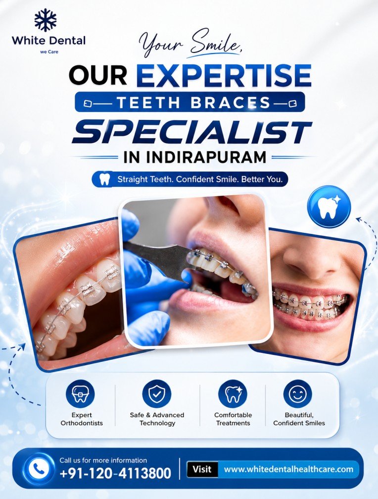 Teeth Braces Specialist in Indirapuram for Perfect Smile Alignment