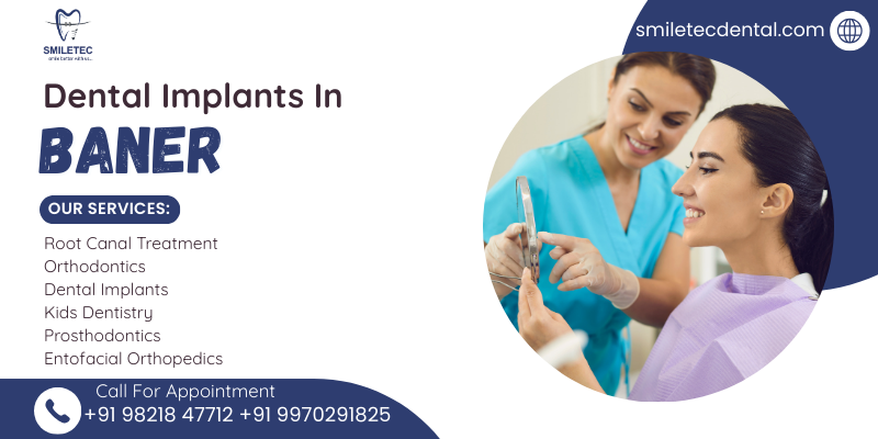 Dental implants in Baner